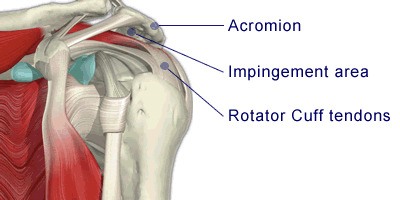 Impingement Syndrome / Acromioclavicular joint (AC Joint) arthritis 