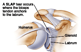 Biceps Tendo Lesions Treatment Berkshire SLAP Tear Oxfordshire Hampshire