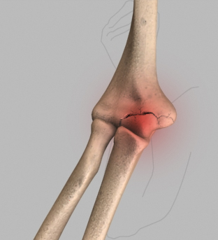 Elbow Fractures and Trauma 