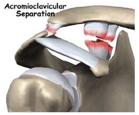 AC Joint Dislocation & Reconstruction