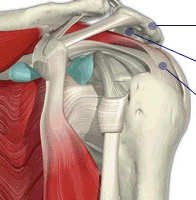 Calcific Tendonitis