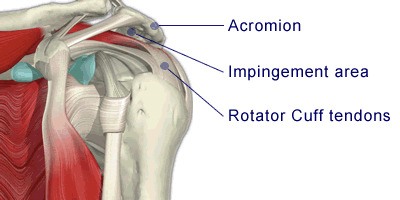 Calcific Tendonitis