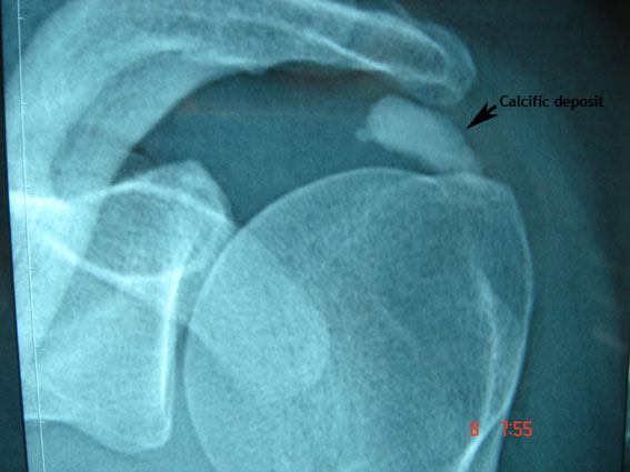 Calcific Tendonitis