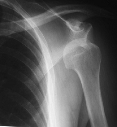 Arthroscopic / Open stabilisation of the shoulder