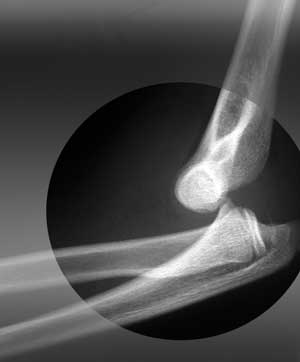 Elbow Instability 