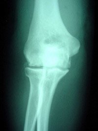 Elbow Osteoarthritis