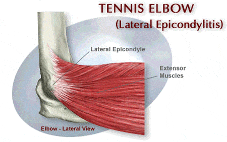 Tennis Elbow