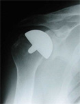 Copeland Surface replacement arthroplasty