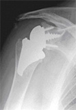 VERSO Reverse shoulder replacement