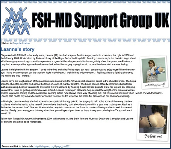 Thoracoscapular Fusion for Fascio-Scapulo-Humeral Dystrophy