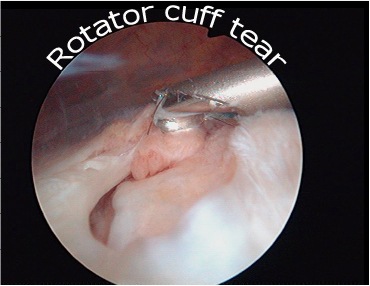 Rotator Cuff tears