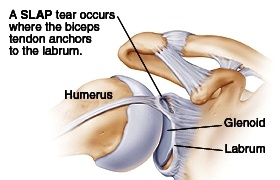 Biceps Disorders / SLAP Tears