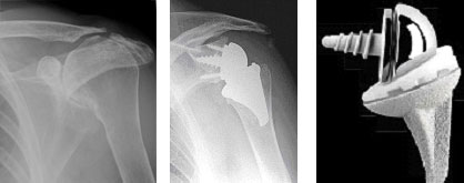 VERSO - Reversed Total Shoulder Replacement